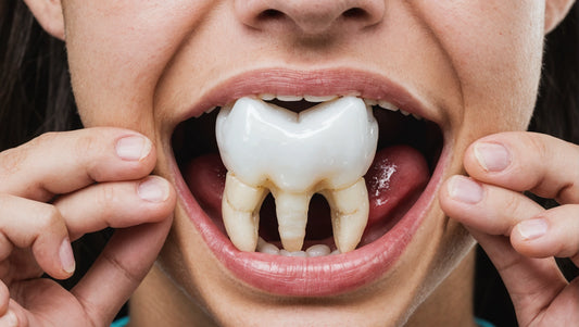 Should I remove wisdom Teeth?